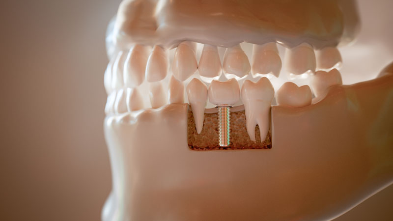3d rendered jaw model with dental implant