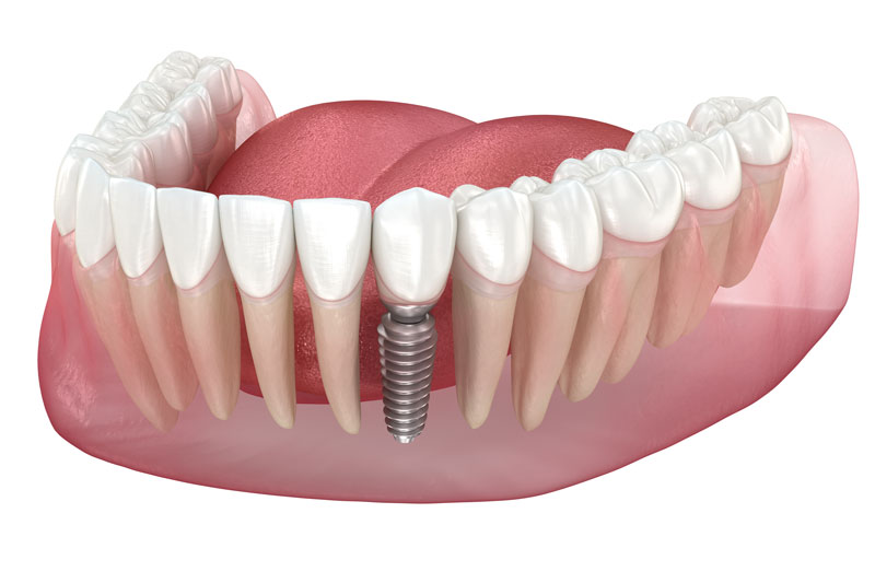 3 rendered image of a lower jaw model with dental implant